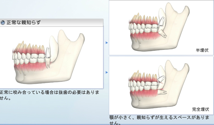 親知らずの生え方