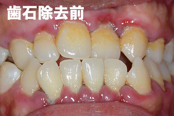 歯石除去の前後比較