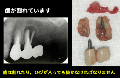 歯が割れている