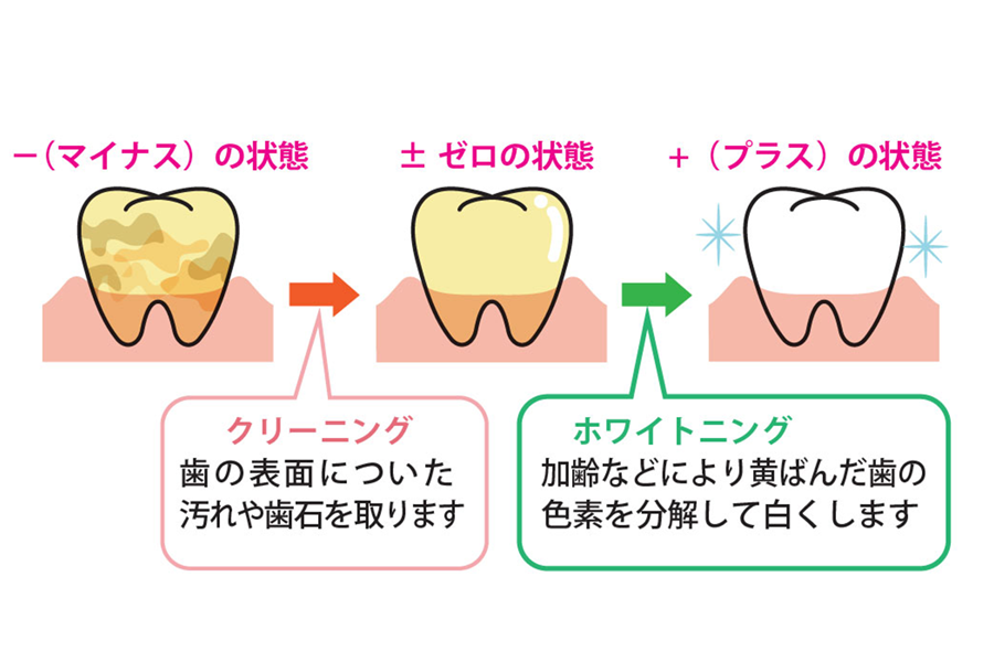 クリーニングとホワイトニングの関係