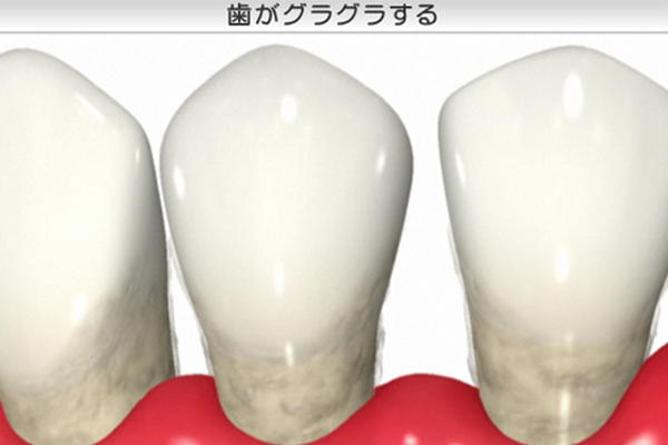 歯がぐらぐらする