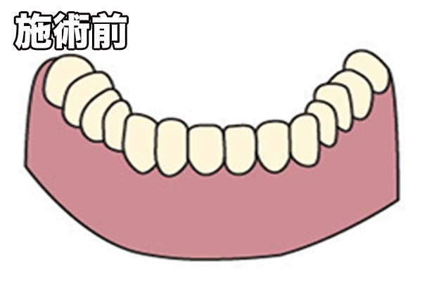 歯ぐきの黒ずみ改善