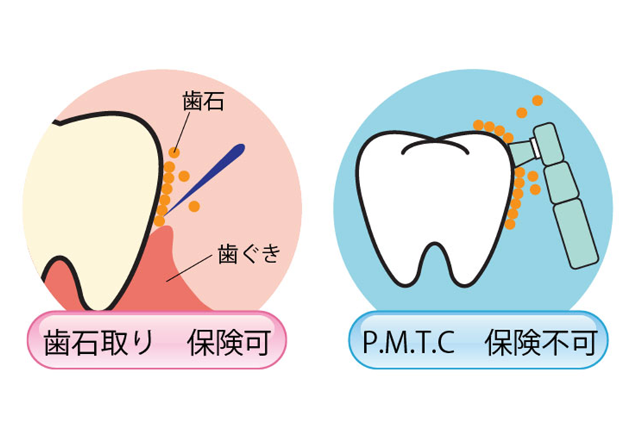 歯石取りとPMTC