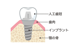 インプラント骨