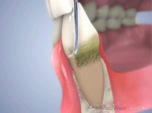 歯周病治療の後に歯茎が痛むことがある
