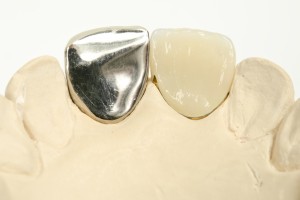 保険の差し歯は金属を使用する