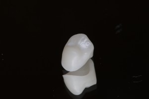 保険の差し歯でも小臼歯は白くできる