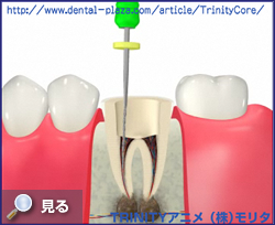 根の治療をすると痛みが出ることがある