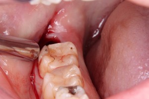 歯を抜いた後は痛みが生じることが多い