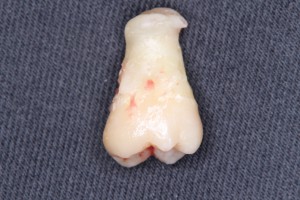 親知らずを抜いて喉が痛むことがある