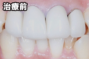 セラミックの差し歯(前歯を4本治療したケース)
