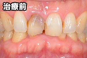 セラミックの差し歯(前歯を1本治療したケース)