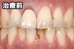 セラミックの差し歯(前歯を1本治療したケース)