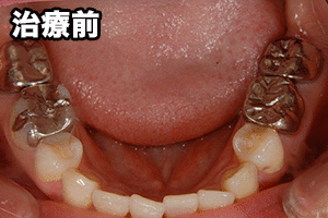 セラミックの詰め物(右下の奥歯を1本治療したケース)