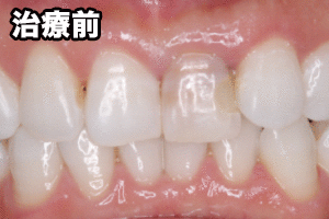 仮歯への置換