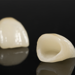 セラミックの差し歯の種類