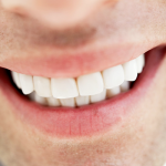 差し歯の特徴